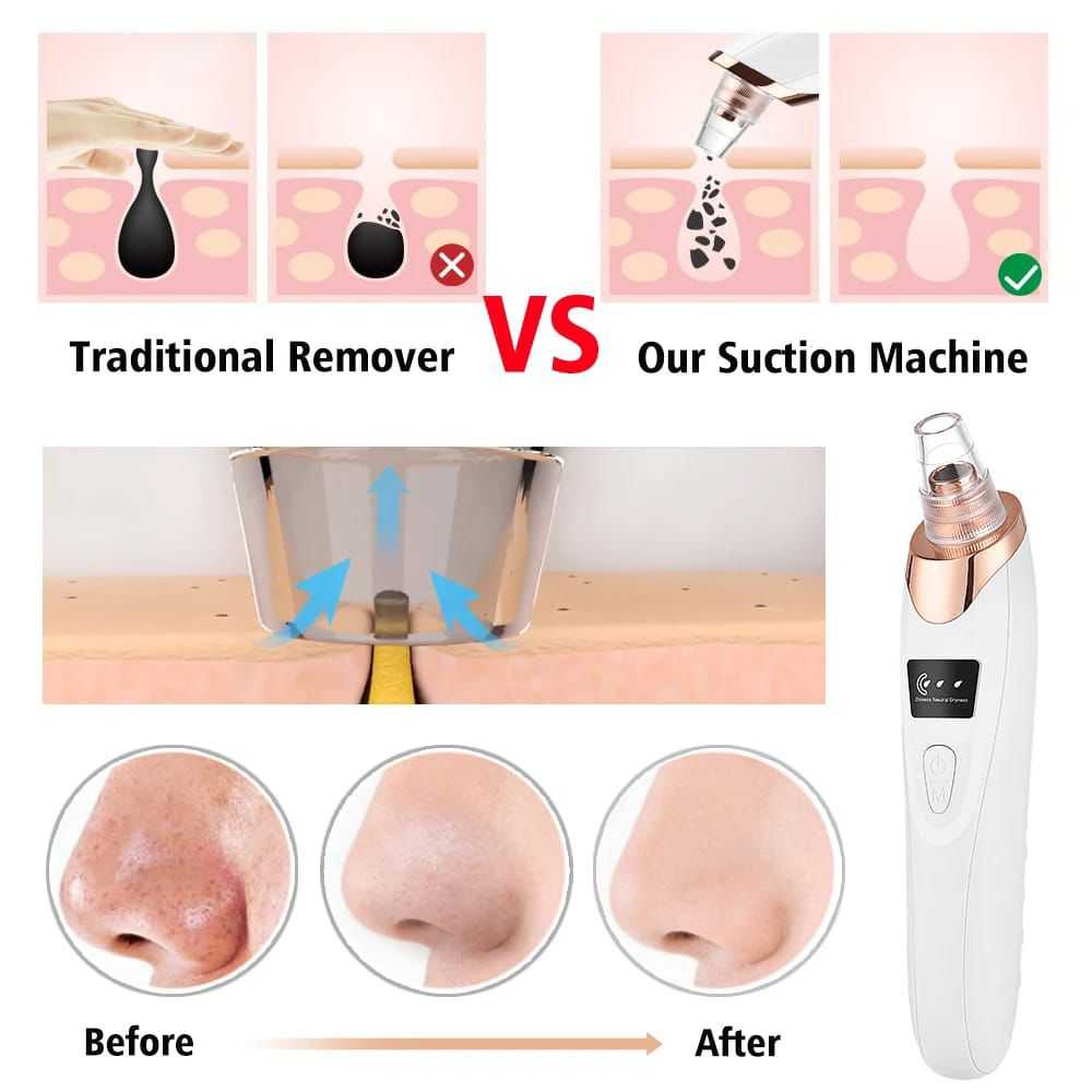 Electric Blackhead Remover Vacuum – Professional Pore Cleaner & Acne Needle Kit