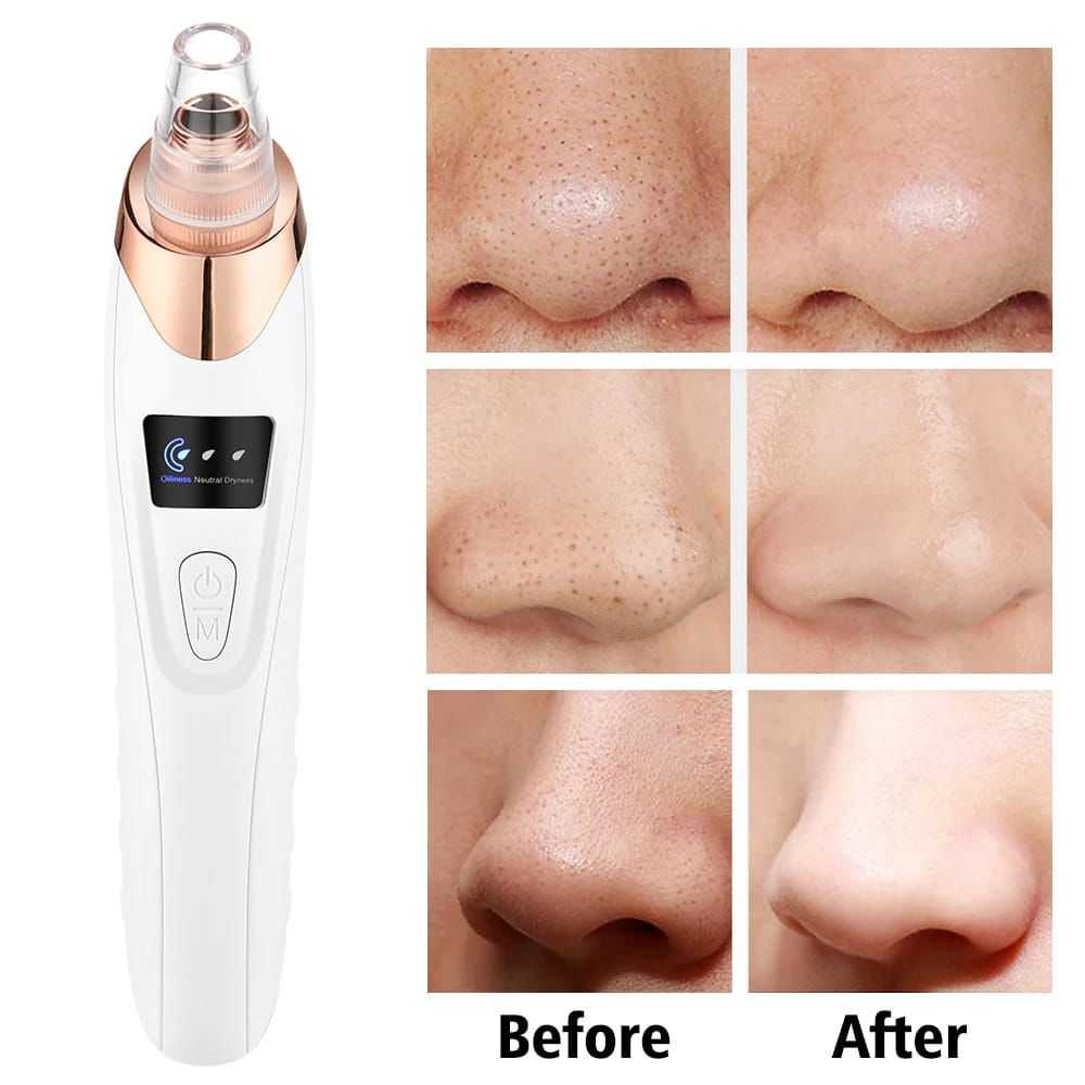Electric Blackhead Remover Vacuum – Professional Pore Cleaner & Acne Needle Kit