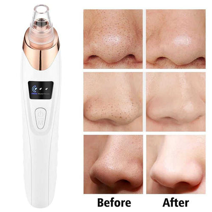 Electric Blackhead Remover Vacuum – Professional Pore Cleaner & Acne Needle Kit
